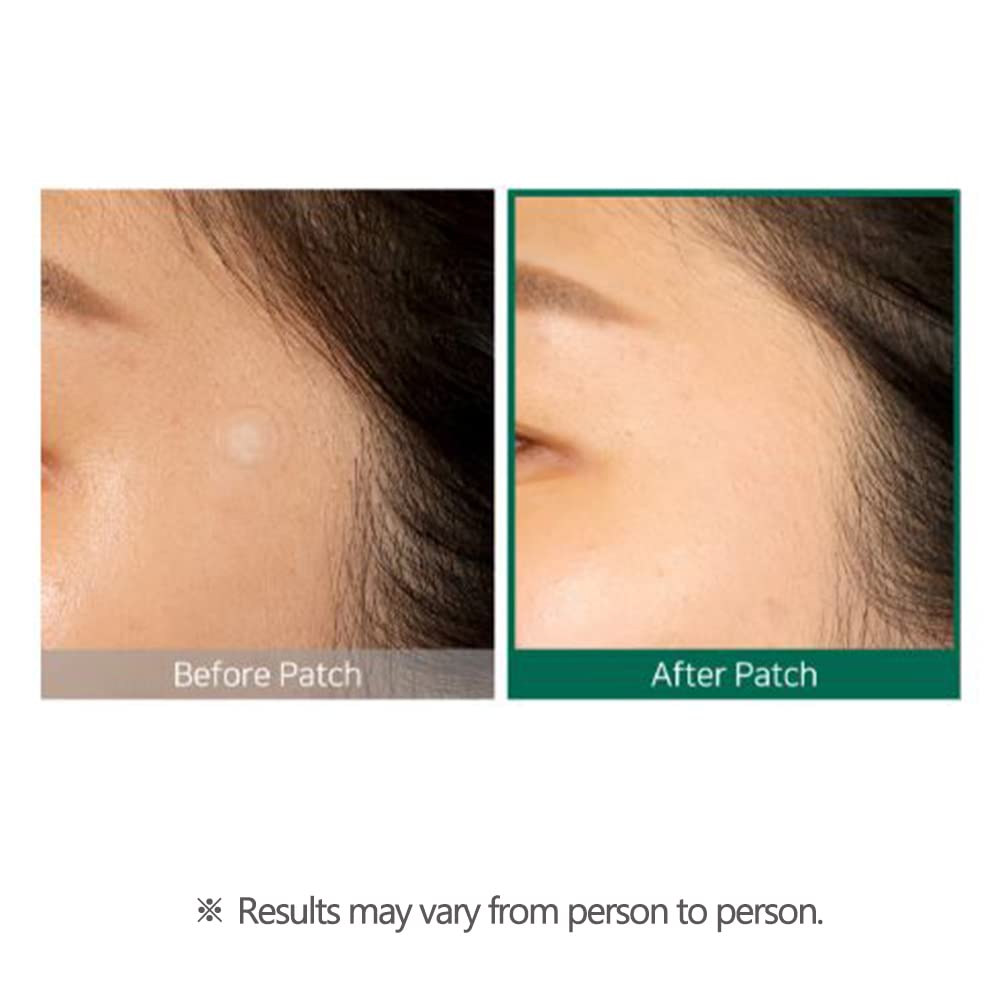 Some By Mi 30 Days Miracle Clear Spot Patch